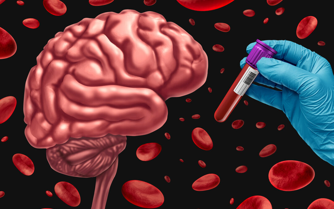 Expert Q&A: A Promising Future for Alzheimer’s Blood Tests