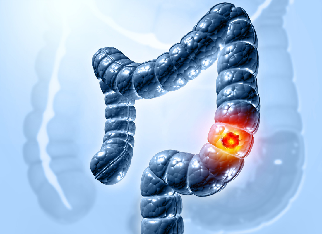 An illustration of the human colon with cancerous mass.